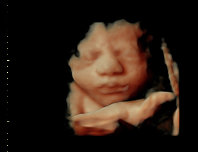 3D ultrasound image at 31 weeks